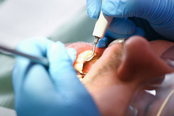 Best Emergency Dentist for Lost Fillings or Crowns in Melwood, MD